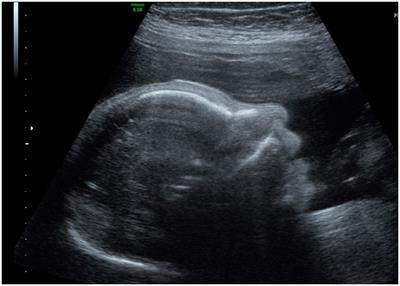 Small size, big problems: insights and difficulties in prenatal diagnosis of fetal microcephaly